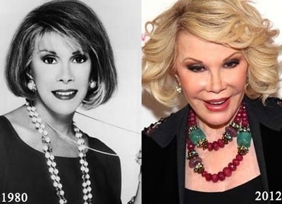 A picture of Joan Rivers before (left) and after (right).